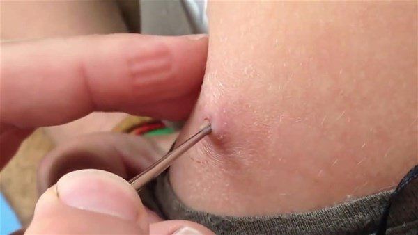 Sivilce zannetti doktora gitti! İçinden çıkanlar şoke etti 9