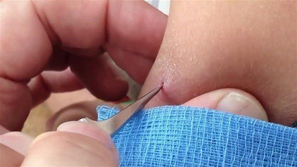 Sivilce zannetti doktora gitti! İçinden çıkanlar şoke etti 7