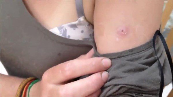 Sivilce zannetti doktora gitti! İçinden çıkanlar şoke etti 1