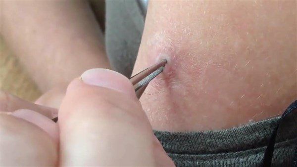 Sivilce zannetti doktora gitti! İçinden çıkanlar şoke etti 8