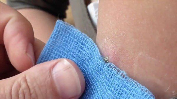 Sivilce zannetti doktora gitti! İçinden çıkanlar şoke etti 3