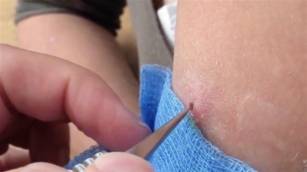 Sivilce zannetti doktora gitti! İçinden çıkanlar şoke etti 4