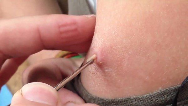 Sivilce zannetti doktora gitti! İçinden çıkanlar şoke etti 10