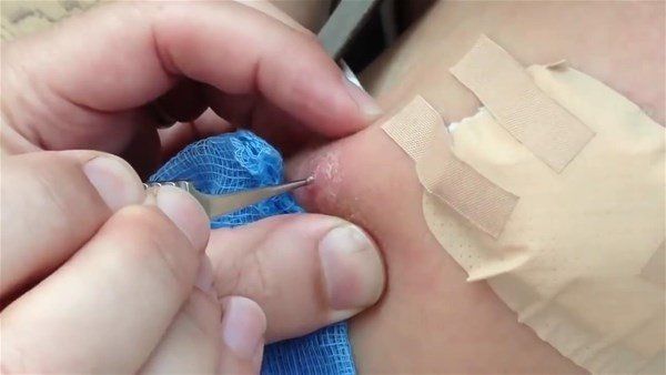 Sivilce zannetti doktora gitti! İçinden çıkanlar şoke etti 15