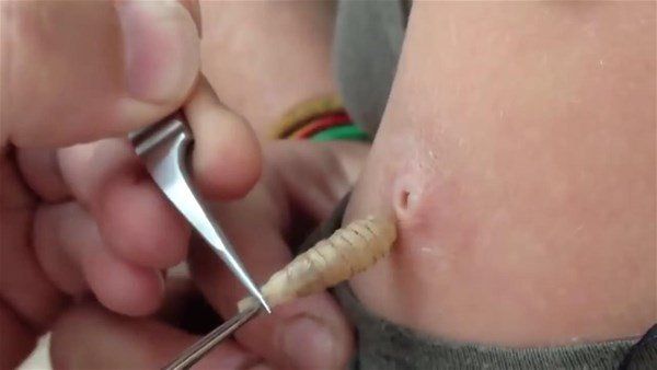 Sivilce zannetti doktora gitti! İçinden çıkanlar şoke etti 13