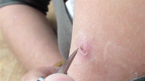 Sivilce zannetti doktora gitti! İçinden çıkanlar şoke etti 2