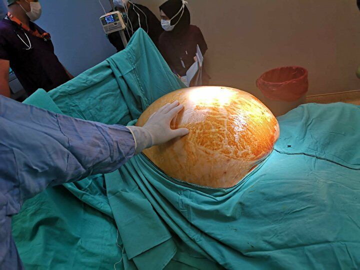 Enfeksiyon sandılar karnından bakın ne çıktı! 3