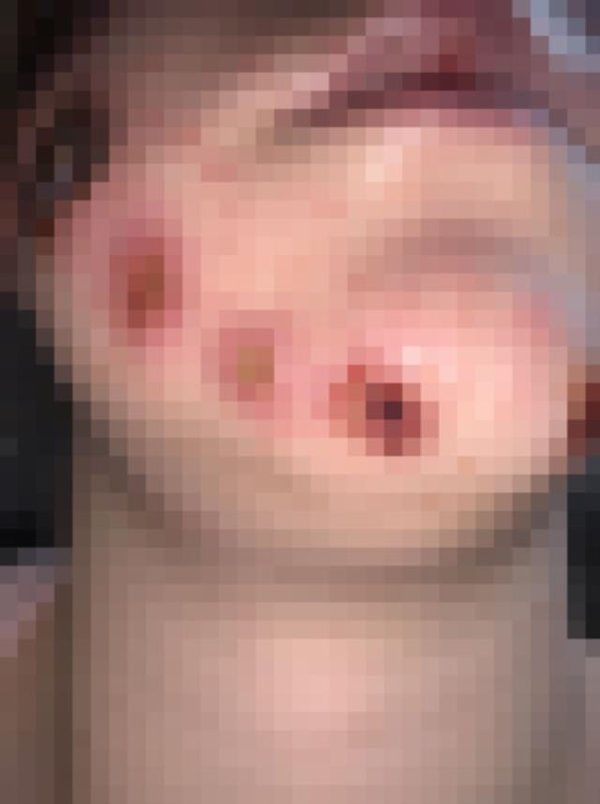 Küçük bir sivilce sandı, korkunç gerçeği sonradan öğrendi 3