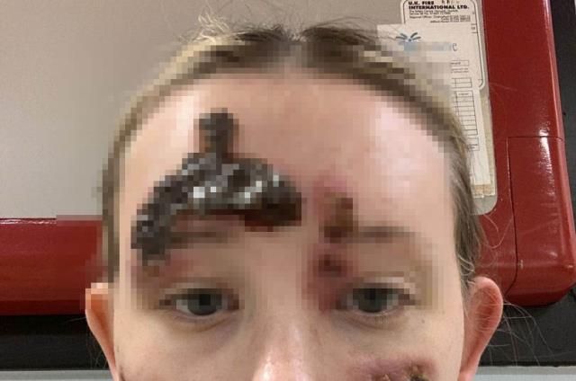 Küçük bir sivilce sandı, korkunç gerçeği sonradan öğrendi 7