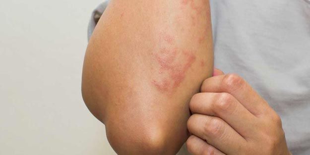 Vücudunuzda bu belirti varsa dikkat! Omicron varyantının yeni belirtisi 3