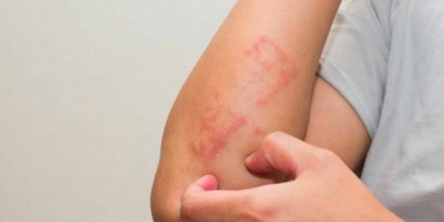 Vücudunuzda bu belirti varsa dikkat! Omicron varyantının yeni belirtisi 2