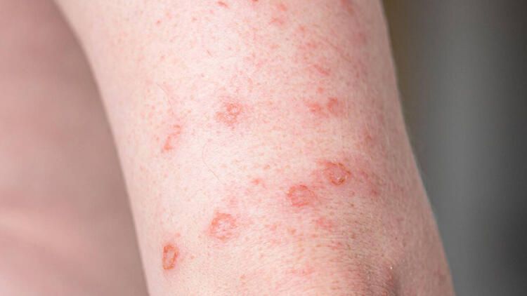 Vücudunuzda bu belirti varsa dikkat! Omicron varyantının yeni belirtisi 7