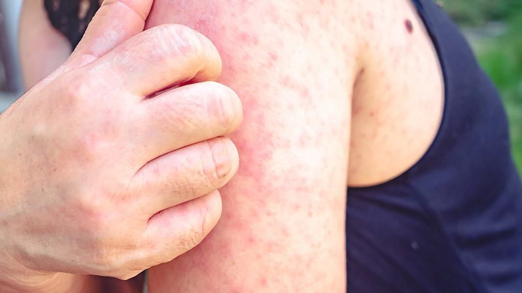 Vücudunuzda bu belirti varsa dikkat! Omicron varyantının yeni belirtisi 4