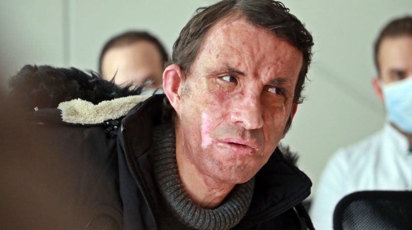 Türkiye'nin ilk yüz naklinin üzerinden 10 yıl geçti! 1