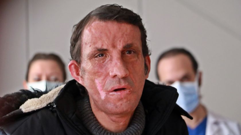 Türkiye'nin ilk yüz naklinin üzerinden 10 yıl geçti! 2