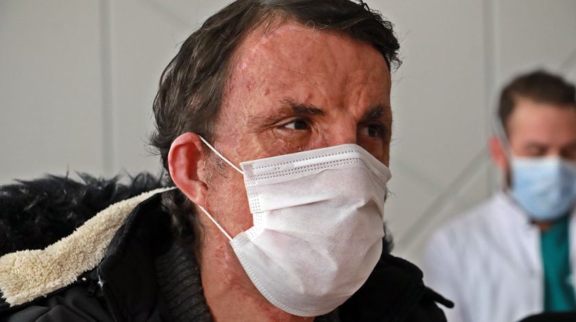 Türkiye'nin ilk yüz naklinin üzerinden 10 yıl geçti! 6