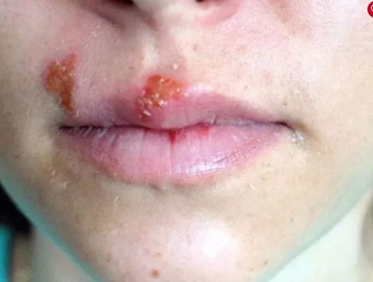 İşte iltihaba meydan okuyan bitki 9