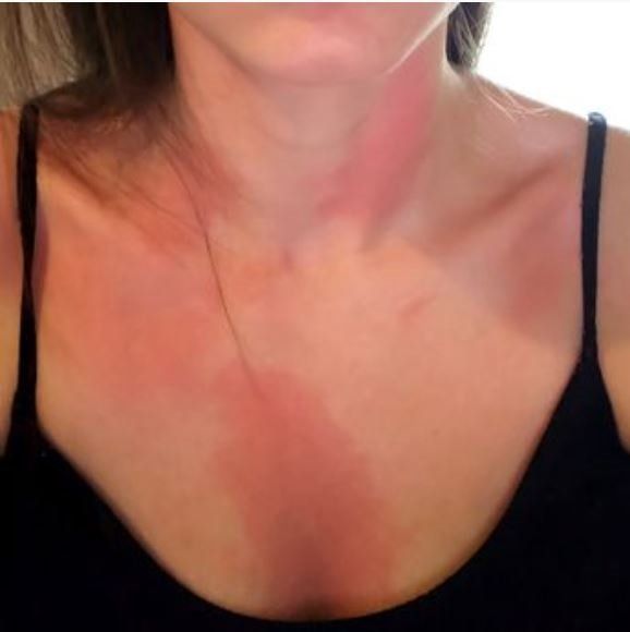 Böcek ısırığı hayatını mahvetti! Sadece 5 gıda ile hayatta kalmaya çalışıyor: Vücudum eriyor sandım 2