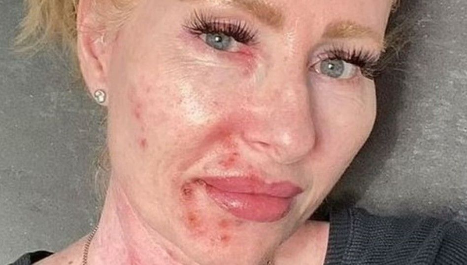 Egzama sandığı lekeler cilt kanseri çıktı! Herkesi uyarıyor: Bu hatayı yapan herkes risk altında… 1