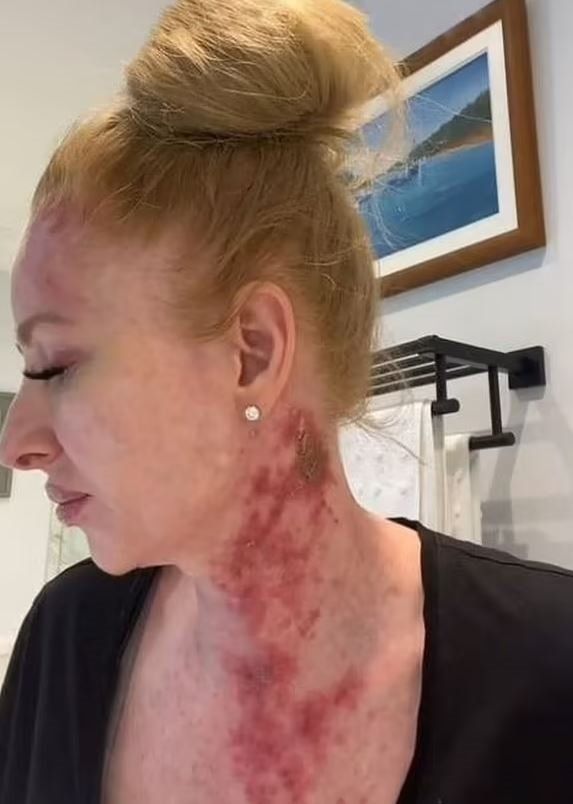 Egzama sandığı lekeler cilt kanseri çıktı! Herkesi uyarıyor: Bu hatayı yapan herkes risk altında… 3