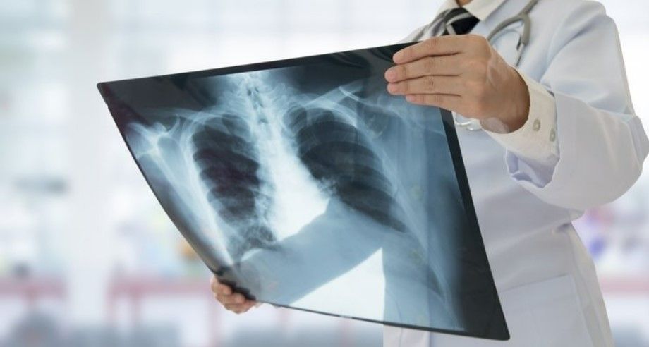 Akciğerleri hızla baştan sona temizliyor! Bu besin doğal antibiyotik gibi 3