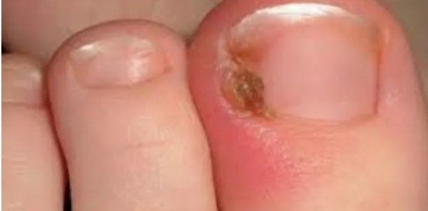 Tırnaklardaki siyah çizgilere dikkat: Uzmanı uyardı! 3