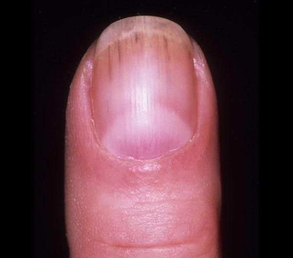 Tırnaklardaki siyah çizgilere dikkat: Uzmanı uyardı! 7