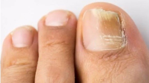 Tırnaklardaki siyah çizgilere dikkat: Uzmanı uyardı! 1