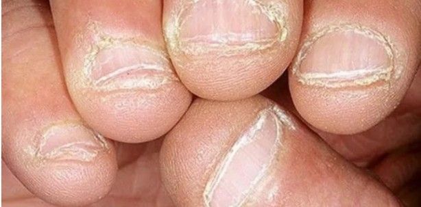 Tırnaklardaki siyah çizgilere dikkat: Uzmanı uyardı! 2