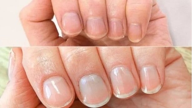 Tırnaklardaki siyah çizgilere dikkat: Uzmanı uyardı! 5