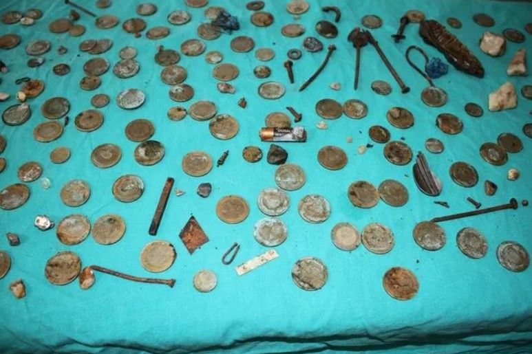 Midesinden çıkanları görenler şoke oldu! 83 tane 1 lira... 1