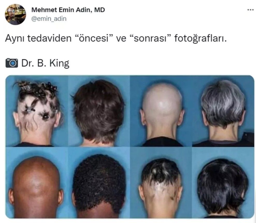 Kel kalma tarihe karışıyor! FDA’in onay verdiği ilaç milyonlara umut oldu 3