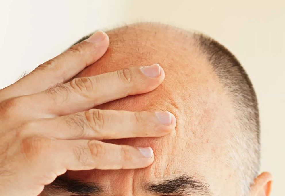 Kel kalma tarihe karışıyor! FDA’in onay verdiği ilaç milyonlara umut oldu 1