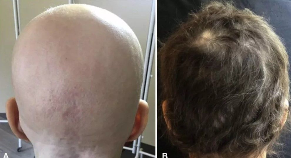 Kel kalma tarihe karışıyor! FDA’in onay verdiği ilaç milyonlara umut oldu 2