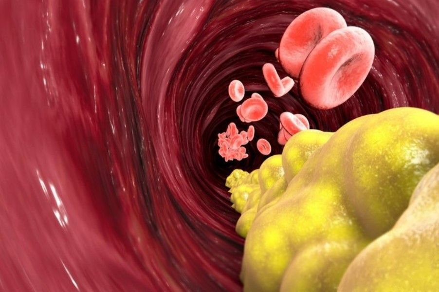 Bu yiyecek damarların düşmanı! Erken ölüme neden oluyor: Tüketmeyin 2