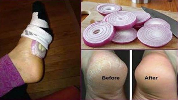 Çorabınızın için yarım soğan koyup sabaha kadar beklerseniz bakın ne olur? Herkes bunu yapıyor 6