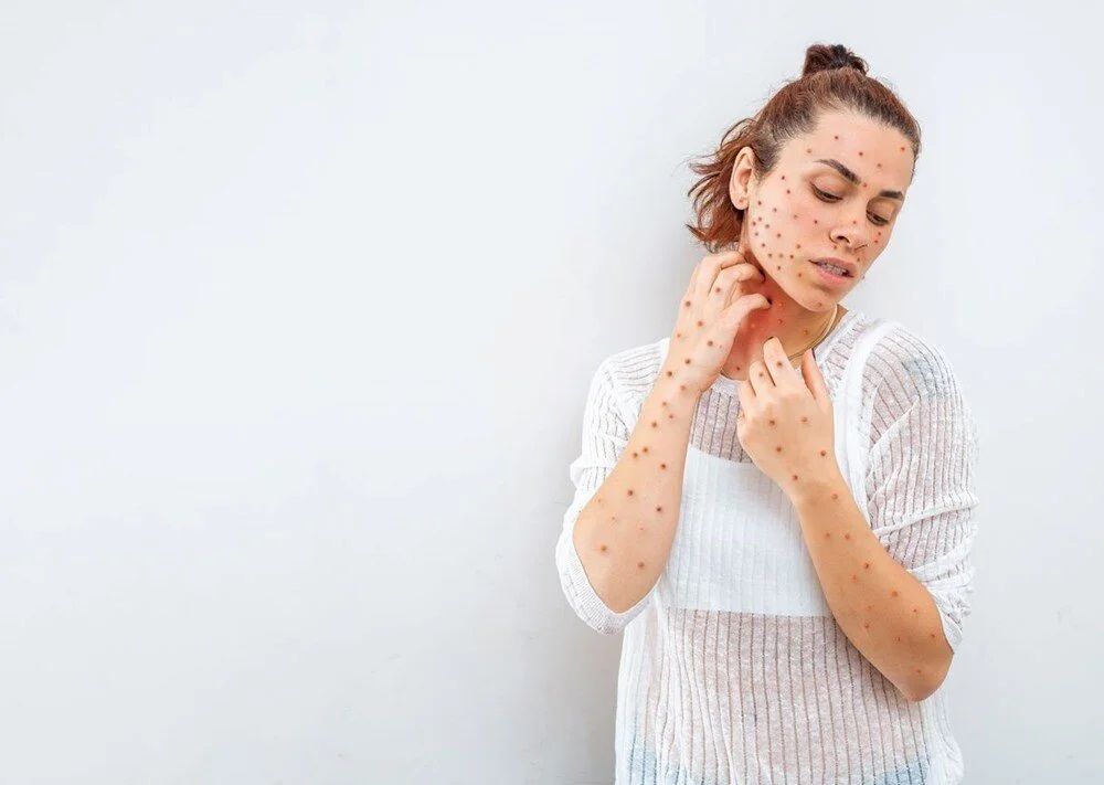 Maymun çiçeği vakaları rekor seviyeye ulaştı 9