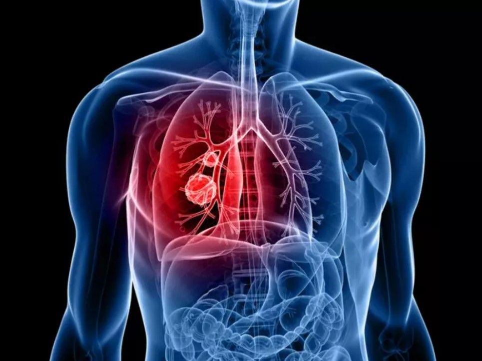 Basit tırnak testi ile kanseri önceden teşhis etmeniz mümkün! Akciğer kanseri için önemli bir adım 2