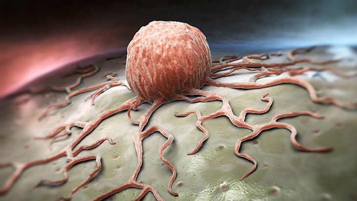 İşte kanser riskini 3 kat arttıran detaylar! En ufak şüphe... 5