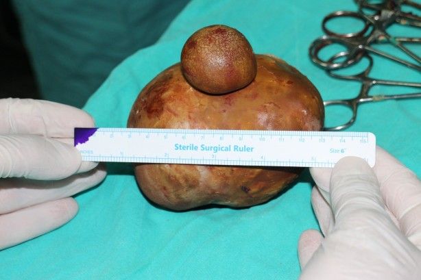 Doktorlar bile neler oluyor dedi! Mesanesinden 1 kilo taş çıktı 2