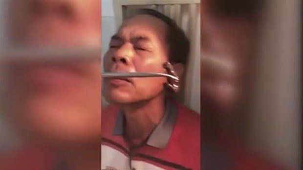 Yer: Zonguldak! 50 yıldır yüzündeydi... Ameliyatla burnundan çıkarılanlar şoke etti 12