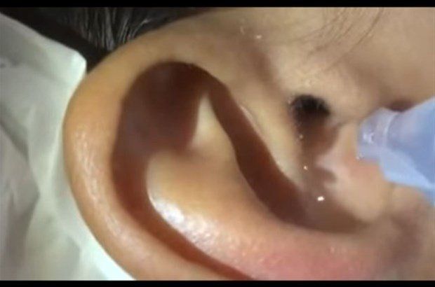 Yer: Zonguldak! 50 yıldır yüzündeydi... Ameliyatla burnundan çıkarılanlar şoke etti 18