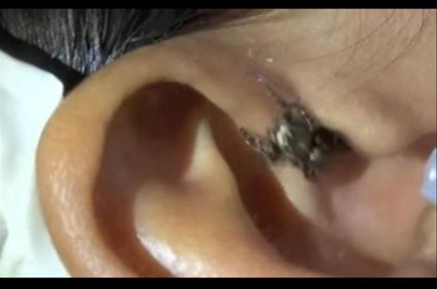 Yer: Zonguldak! 50 yıldır yüzündeydi... Ameliyatla burnundan çıkarılanlar şoke etti 22