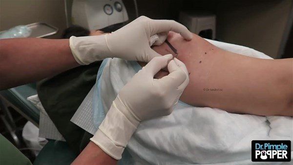 Yer: Zonguldak! 50 yıldır yüzündeydi... Ameliyatla burnundan çıkarılanlar şoke etti 26