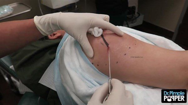 Yer: Zonguldak! 50 yıldır yüzündeydi... Ameliyatla burnundan çıkarılanlar şoke etti 28