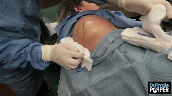 Yer: Zonguldak! 50 yıldır yüzündeydi... Ameliyatla burnundan çıkarılanlar şoke etti 31