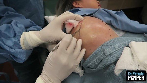 Yer: Zonguldak! 50 yıldır yüzündeydi... Ameliyatla burnundan çıkarılanlar şoke etti 33