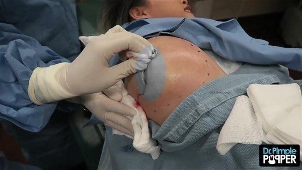 Yer: Zonguldak! 50 yıldır yüzündeydi... Ameliyatla burnundan çıkarılanlar şoke etti 34