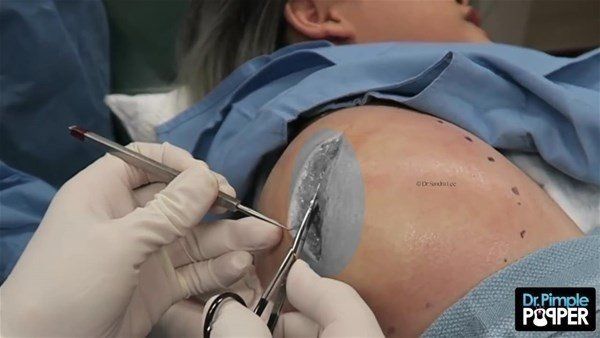 Yer: Zonguldak! 50 yıldır yüzündeydi... Ameliyatla burnundan çıkarılanlar şoke etti 36