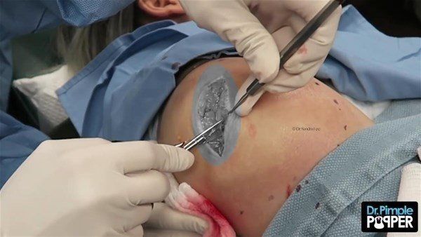 Yer: Zonguldak! 50 yıldır yüzündeydi... Ameliyatla burnundan çıkarılanlar şoke etti 38